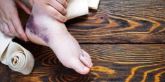 كيفية علاج كدمات القدم