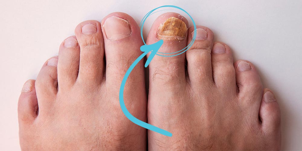 كيفية علاج فطريات الأظافر