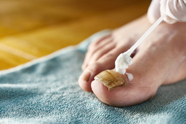 كيفية علاج فطريات الأظافر